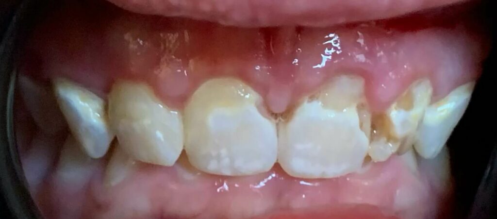 Dental Crown Patient in Shreveport, LA at Shreveport Dental Solutions