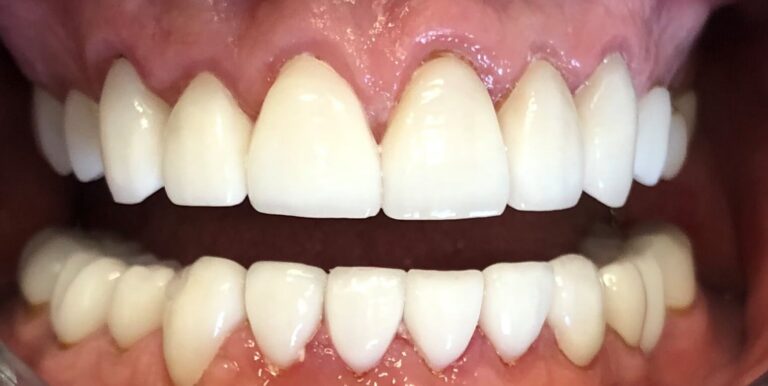 Dental Crown Patient in Shreveport, LA at Shreveport Dental Solutions