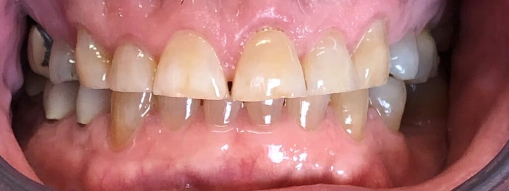 Dental Crown Patient in Shreveport, LA at Shreveport Dental Solutions