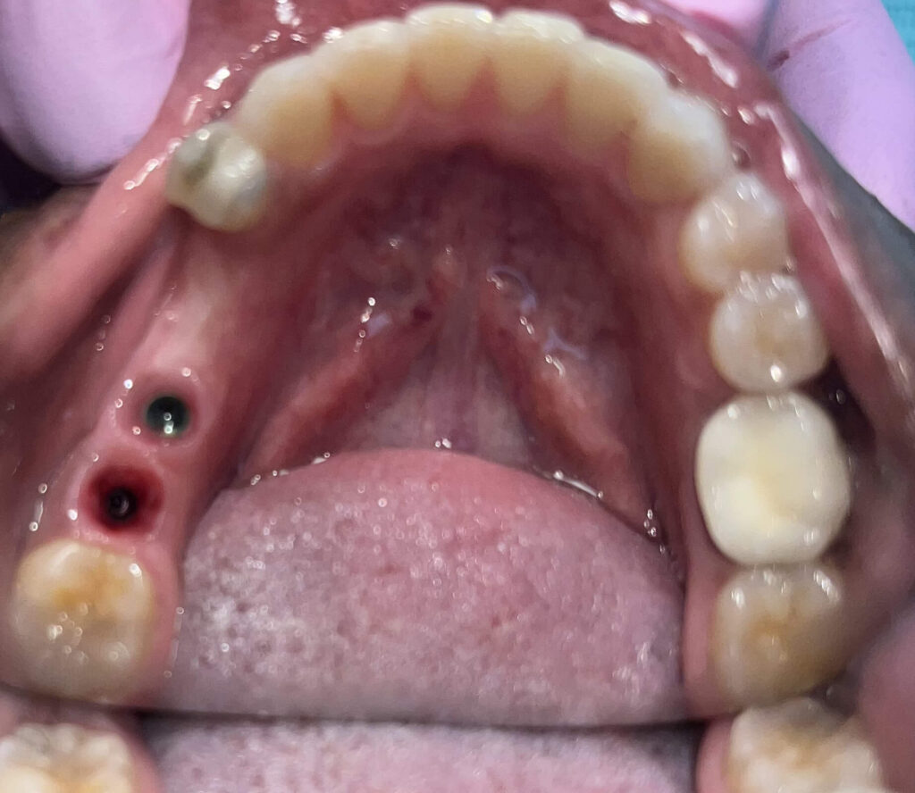 Dental Implant Patient in Shreveport, LA at Shreveport Dental Solutions