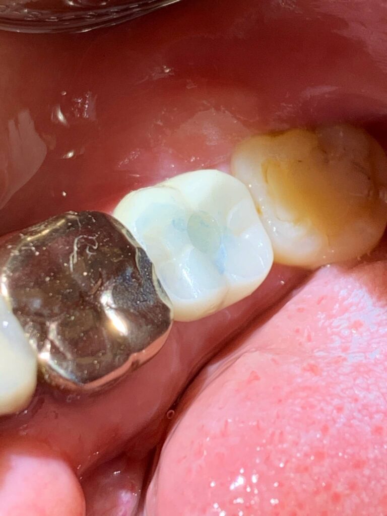 Dental Implant Patient in Shreveport, LA at Shreveport Dental Solutions