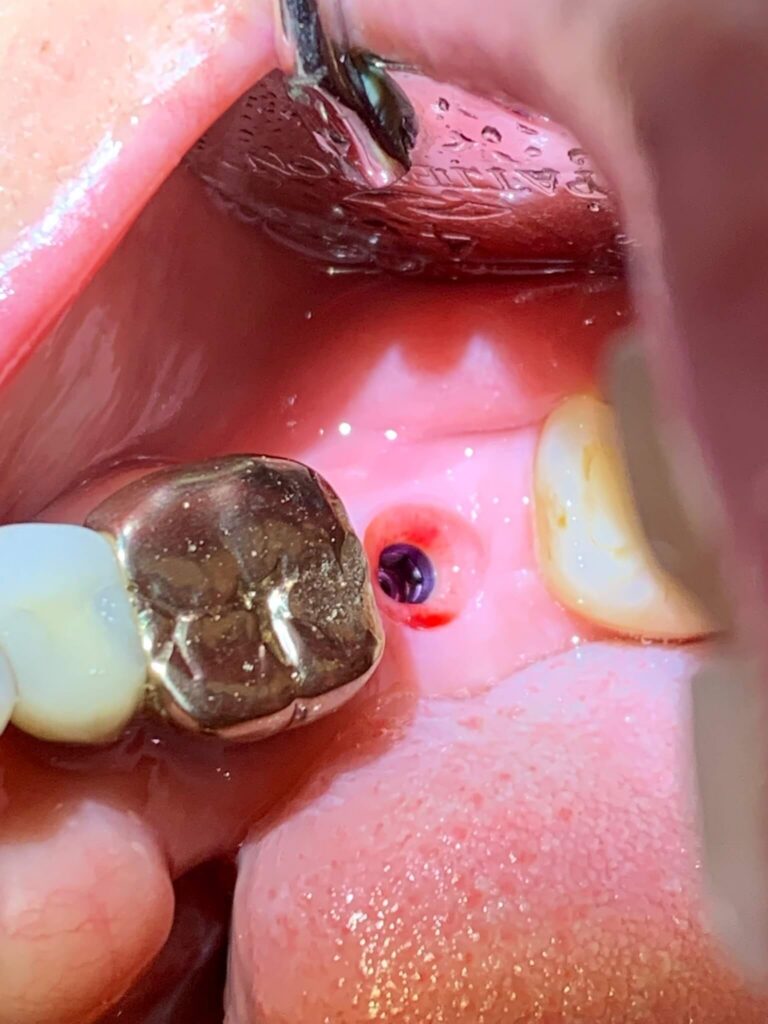 Dental Implant Patient in Shreveport, LA at Shreveport Dental Solutions