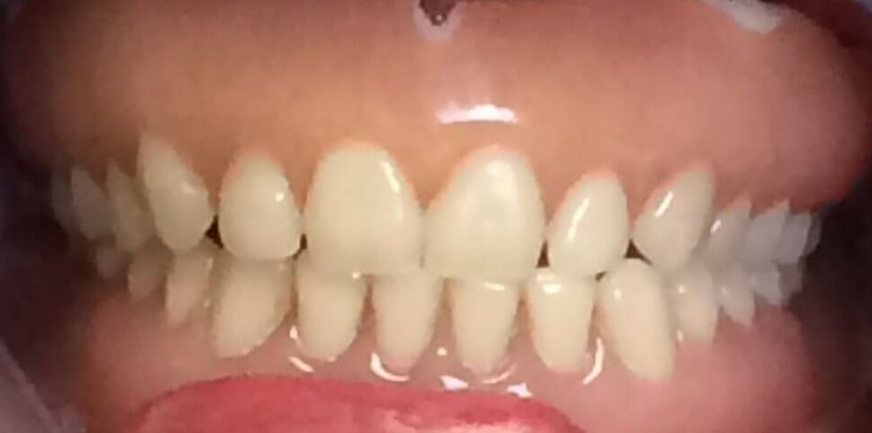 Dental Implant Patient in Shreveport, LA at Shreveport Dental Solutions