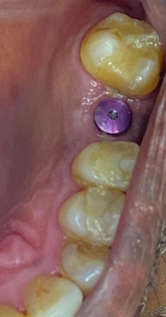 Dental Implant Patient in Shreveport, LA at Shreveport Dental Solutions