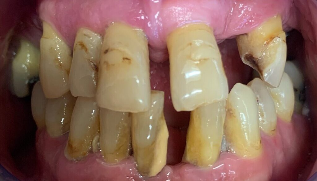 Dental Implant Patient in Shreveport, LA at Shreveport Dental Solutions