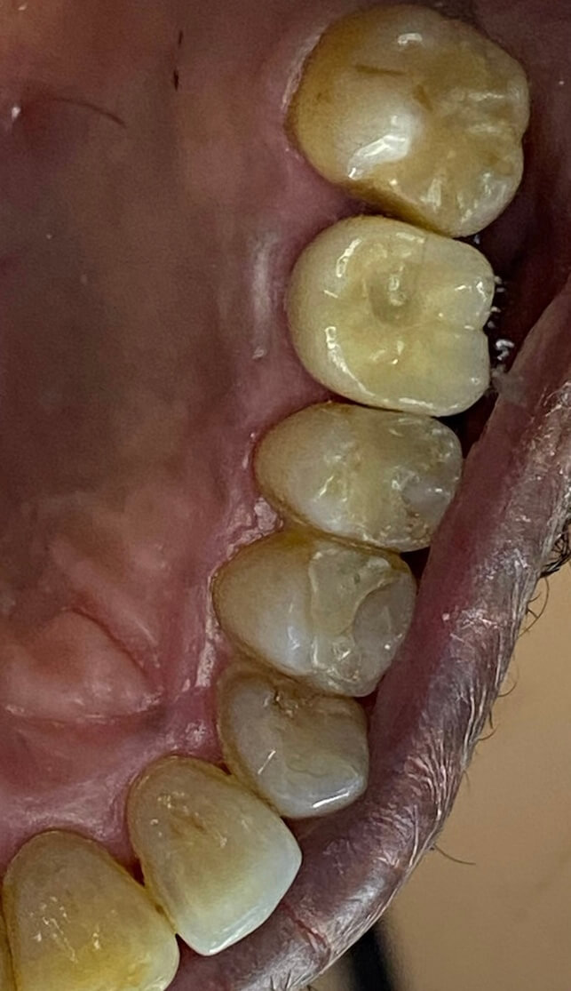 Dental Implant Patient in Shreveport, LA at Shreveport Dental Solutions