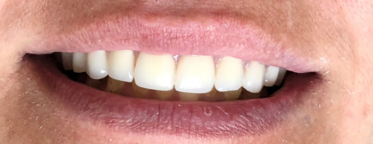 Dental Implant Patient in Shreveport, LA at Shreveport Dental Solutions