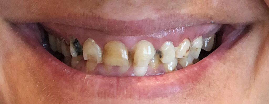 Dental Implant Patient in Shreveport, LA at Shreveport Dental Solutions