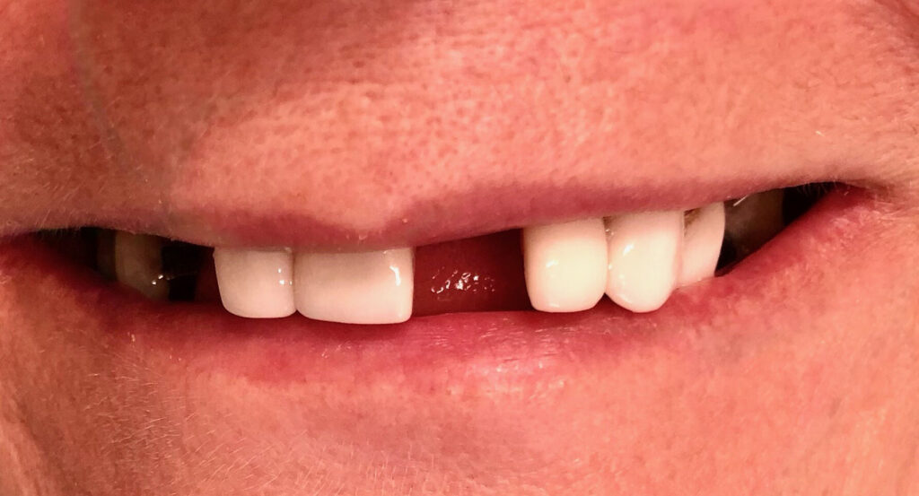 Dental Implant Patient in Shreveport, LA at Shreveport Dental Solutions