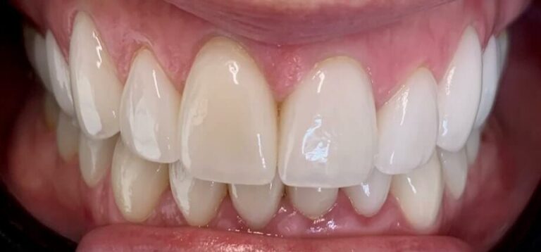 Dental Veneers Patient in Shreveport, LA at Shreveport Dental Solutions