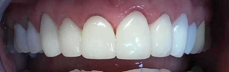 Dental Veneers Patient in Shreveport, LA at Shreveport Dental Solutions