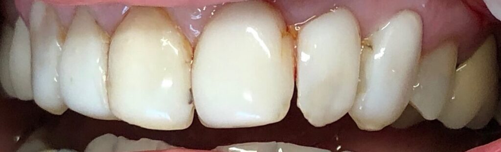 Dental Veneers Patient in Shreveport, LA at Shreveport Dental Solutions
